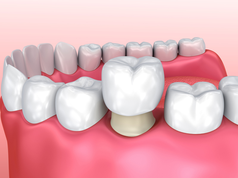 delta dental crowns
