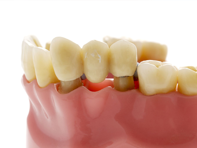 dental bridge