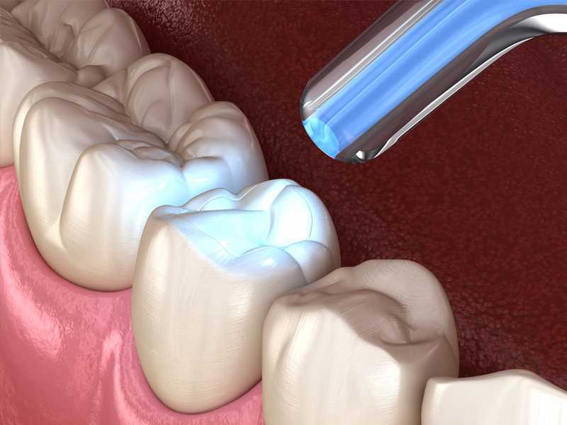 dental fillings
