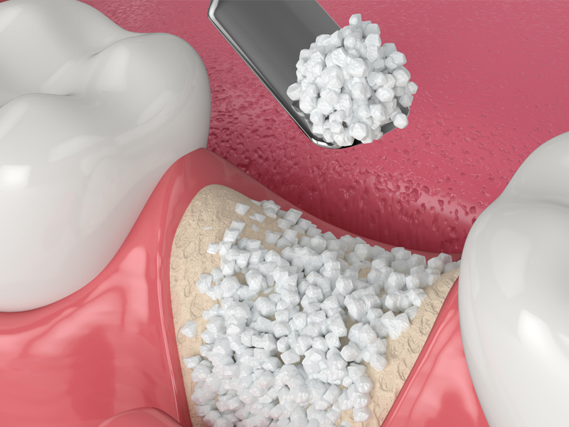 sunstone bone graft