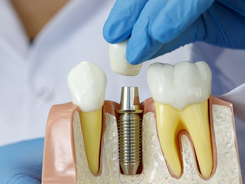 sunstone dental implants