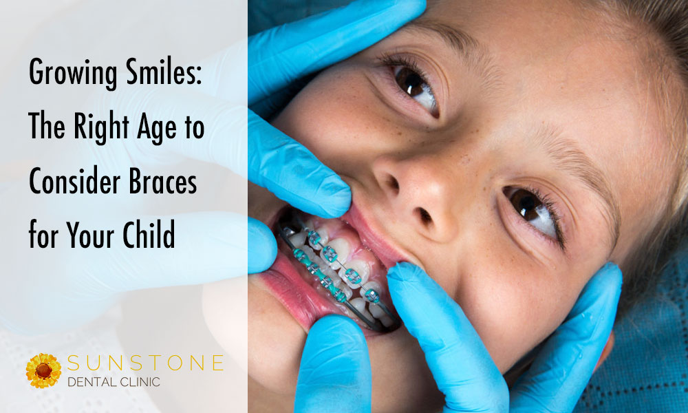 sunstone blog braces
