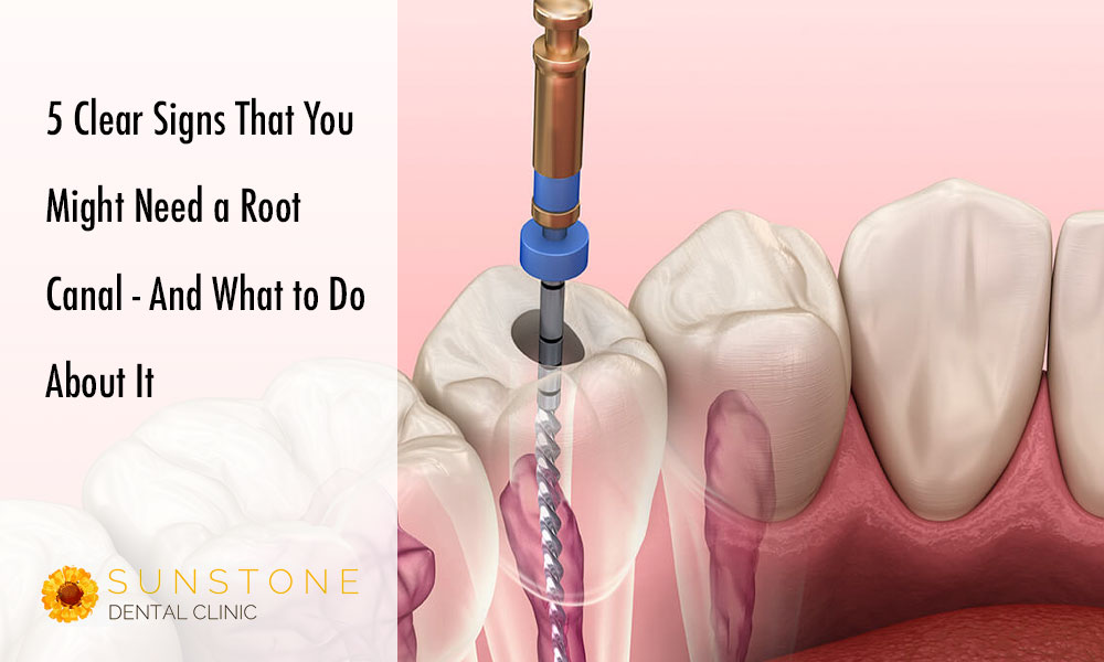 sunstone blog rootcanalsigns