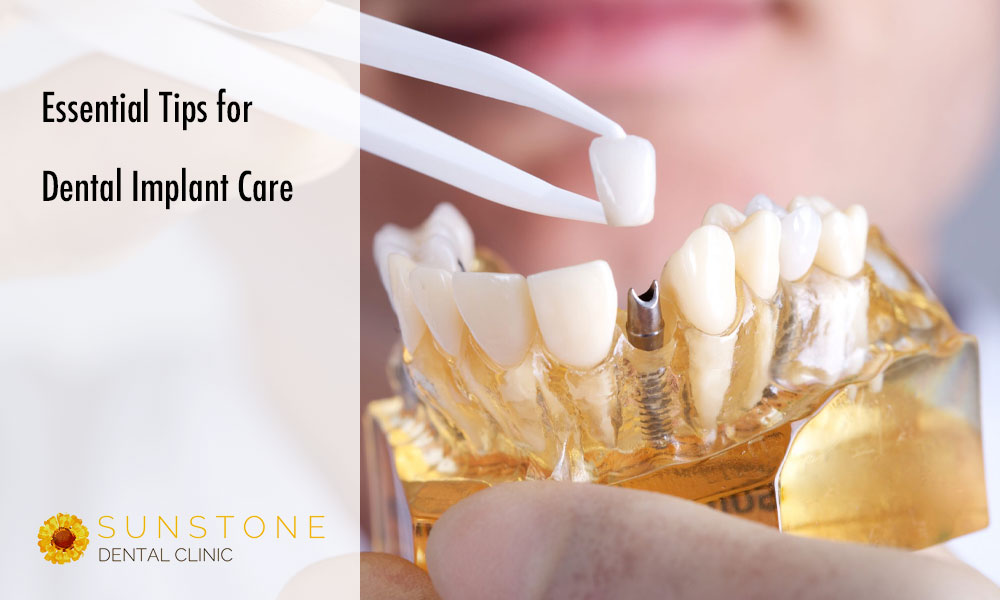 sunstone blog implant